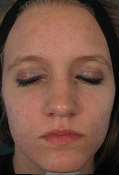 Acne Treatment Patient 4 Patient1 Set1 After Page