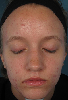 Acne Treatment Patient 4 Patient1 Set1 Before Page