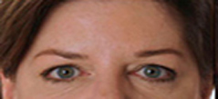 Botox Treatment Patient 5 Patient1 Set1 After