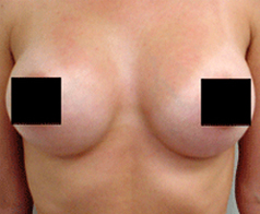 Breast Augmentation Patient 1 Patient1 Set1 After Page