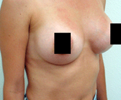 Breast Augmentation Patient 2 Patient1 Set1 After