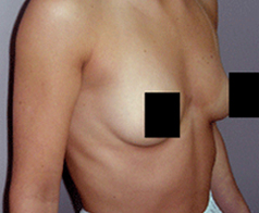 Breast Augmentation Patient 2 Patient1 Set1 Before