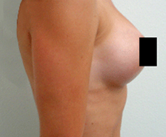 Breast Augmentation Patient 3 Patient1 Set1 After