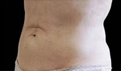 Coolsculpting Patient 2 Patient1 Set1 After