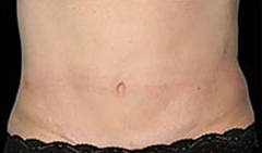 Coolsculpting Patient 3 Patient1 Set1 After Page