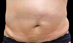 Coolsculpting Patient 3 Patient1 Set1 Before