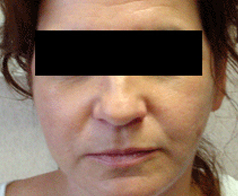 Facelift (Rhytidectomy) Patient 1 Patient1 Set1 After