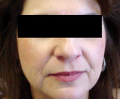 Facelift (Rhytidectomy) Patient 1 Patient1 Set1 Before