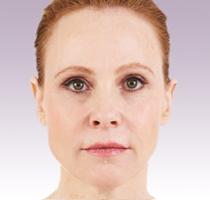 Juvederm XC Patient 2 Patient1 Set1 After