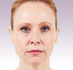 Juvederm XC Patient 2 Patient1 Set1 Before