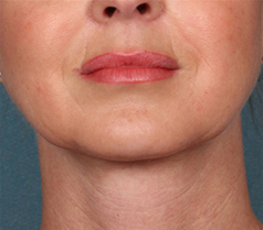 Kybella Patient 1 Patient1 Set1 After