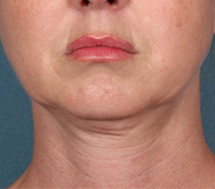 Kybella Patient 1 Patient1 Set1 Before