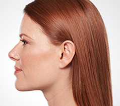 Kybella Patient 2 Patient1 Set1 After