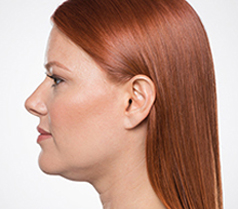 Kybella Patient 2 Patient1 Set1 Before