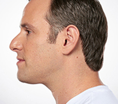 Kybella Patient 3 Patient1 Set1 After