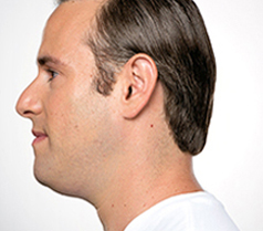 Kybella Patient 3 Patient1 Set1 Before