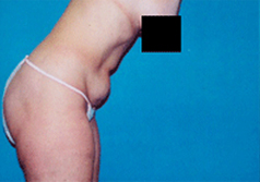 Liposuction Patient 1 Patient1 Set1 Before