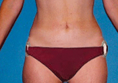 Liposuction Patient 2 Patient1 Set1 After Page