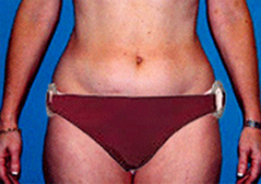 Medial Thigh Lift Patient 1 Patient1 Set1 Before