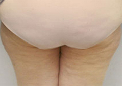 Medial Thigh Lift Patient 2 Patient1 Set1 After