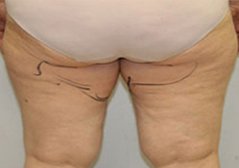 Medial Thigh Lift Patient 2 Patient1 Set1 Before