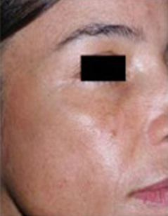 Melasma Patient 1 Patient1 Set1 After Page