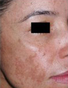 Melasma Patient 1 Patient1 Set1 Before Page