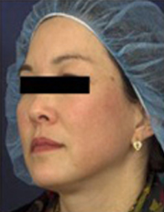 Melasma Patient 2 Patient1 Set1 After