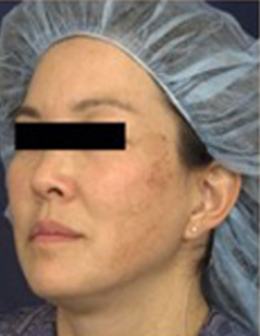 Melasma Patient 2 Patient1 Set1 Before