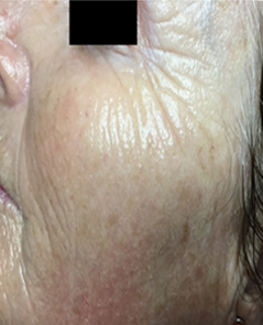 Microneedling Patient 2 Patient1 Set1 After Page