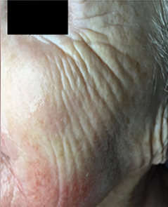 Microneedling Patient 2 Patient1 Set1 Before