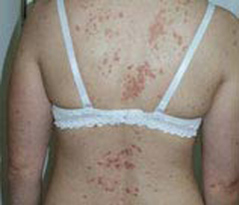 Psoriasis Patient 1 Patient1 Set1 Before