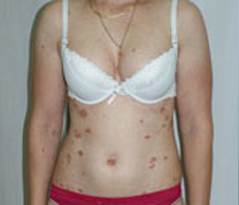 Psoriasis Patient 2 Patient1 Set1 Before