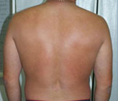 Psoriasis Patient 3 Patient1 Set1 After