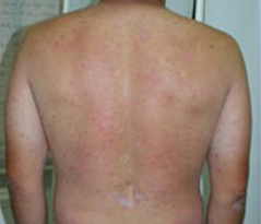 Psoriasis Patient 3 Patient1 Set1 Before