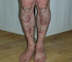 Psoriasis Patient 4 Patient1 Set1 Before Page