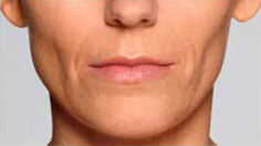 Restylane Defyne Patient 1 Patient1 Set1 Before