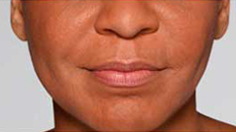 Restylane Defyne Patient 2 Patient1 Set1 After Page