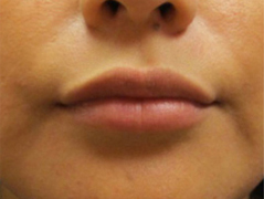 Restylane Patient 1 Patient1 Set1 After