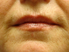 Restylane Patient 2 Patient1 Set1 After