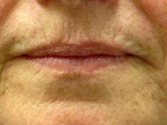 Restylane Patient 2 Patient1 Set1 Before