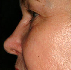Skin Rejuvenation Patient 1 Patient1 Set1 After Page