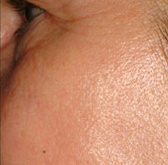 Skin Rejuvenation Patient 2 Patient1 Set1 After Page