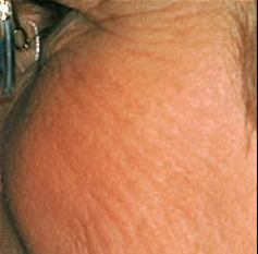 Skin Rejuvenation Patient 2 Patient1 Set1 Before