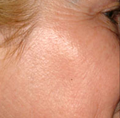 Skin Rejuvenation Patient 3 Patient1 Set1 After Page