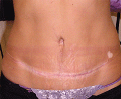 Tummy Tuck (Abdominoplasty) Patient 1 Patient1 Set1 After