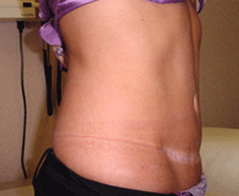 Tummy Tuck (Abdominoplasty) Patient 2 Patient1 Set1 After