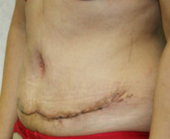 Tummy Tuck (Abdominoplasty) Patient 4 Patient1 Set1 After