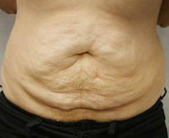 Tummy Tuck (Abdominoplasty) Patient 4 Patient1 Set1 Before