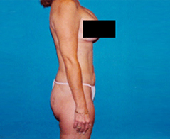 Tummy Tuck (Abdominoplasty) Patient 5 Patient1 Set1 After